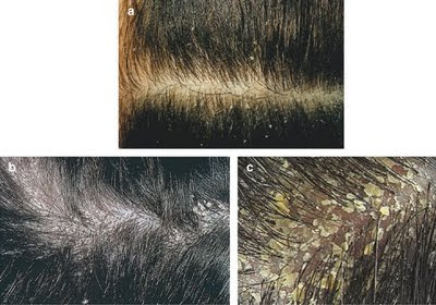  Flaky Scalp on This Condition Should Not Be Confused With A Flaky Scalp