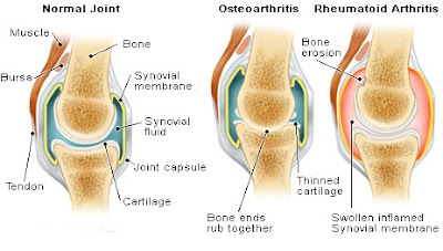 Obat Herbal Pengapuran Tulang (Osteoarthritis) Tanpa Efek Samping