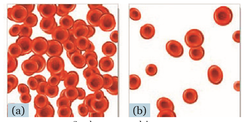 Gambar (a) Jumlah Sel Darah Merah dalam Kondisi Normal dan (b) Penderita Anemia