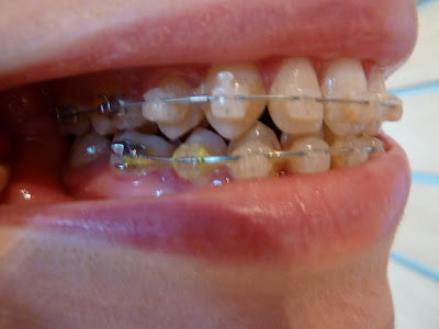 A photo of my teeth 34 weeks into orthodontic treatment