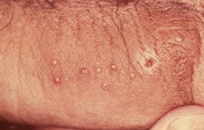 Vaccine For Herpes Genital