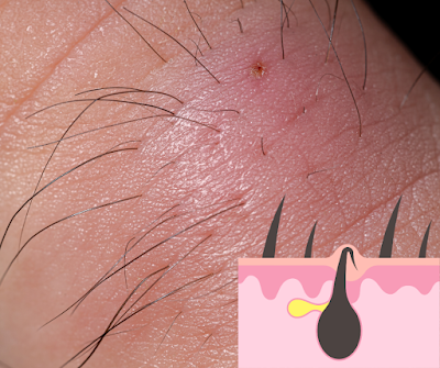 Voici 6 Astuces Géniales pour Traiter les Poils Incarnés