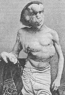 Joseph Merrick en 1886