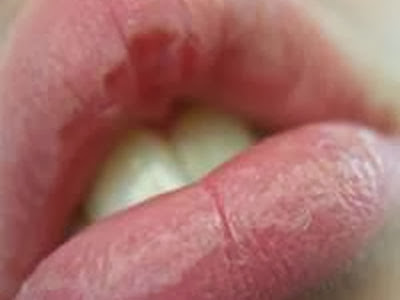 tanda hiv infeksi jamur pada mulut