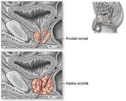 Obat herbal kanker prostat