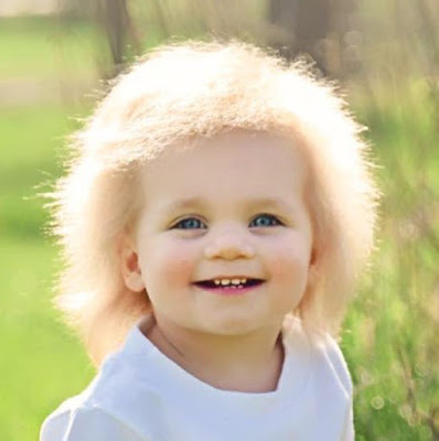 Uncombable unusual hair on a kid