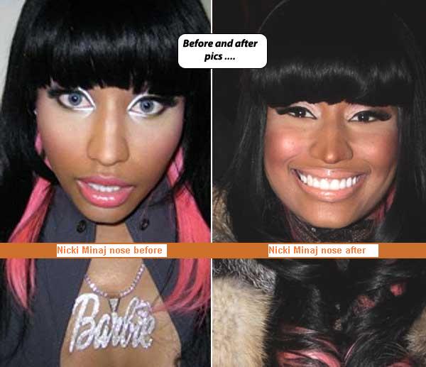 nicki minaj before and after pictures of plastic surgery. nicki minaj plastic surgery