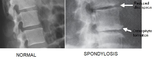 SPONDYLOSIS EXERCISES, CAUSES, SYMPTOMS, TREATMENT