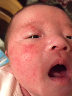 幼児性湿疹