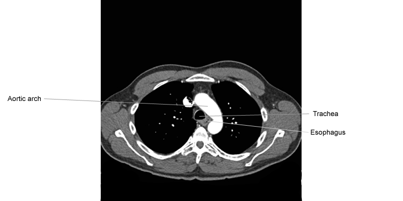 CT Scan Thorax
