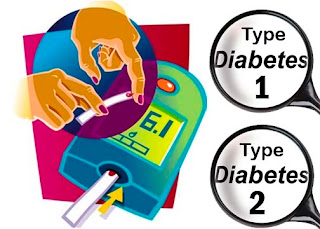 Type 1 diabetes, sometimes called juvenile diabetes is a condition whereby blood sugar levels are above the normal range, this happens when the body is no longer producing the hormone insulin, which carries glucose into your cells where it can be converted into energy.