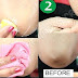 Skin Whitening For Dark Knees & Dark Elbows (LIVE RESULTS) By Simple Beauty Secrets