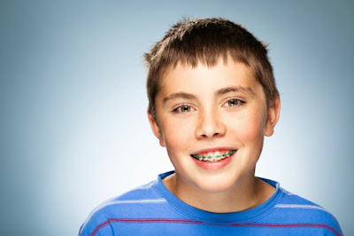 Phương pháp chỉnh nha niềng răng không nhổ răng