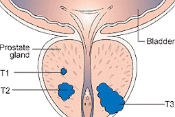 PROSTATE CANCER STAGING