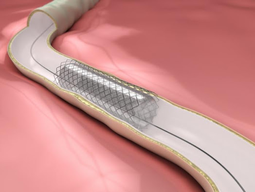 Biodegradable Stents