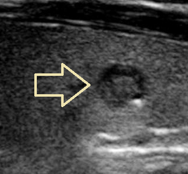Punctate Echogenic Foci Thyroid Ultrasound