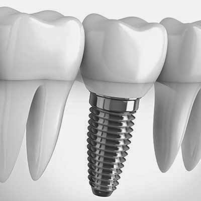 Best Dental Implant specialist in New Delhi, India