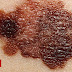 Câncer de pele: como identificar se pintas, manchas e outros sinais podem indicar doença