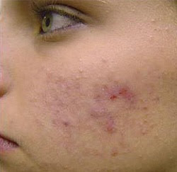 http://healthy-lifestyle20.blogspot.com/2016/01/how-to-clear-acne-scars-naturally-fast.html