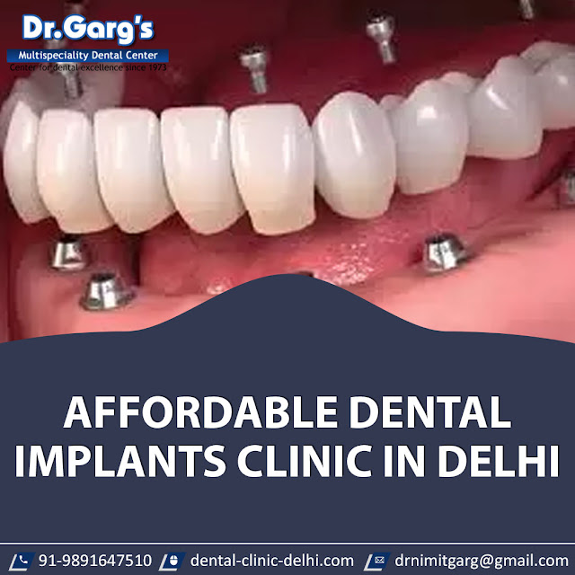 tooth Implant cost in Delhi