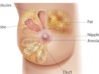  Breast cancer - Symptoms and causes