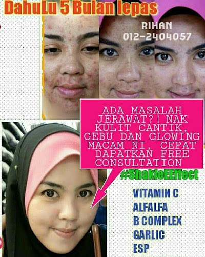 SELESAIKAN MASALAH JERAWAT DENGAN SET JERAWAT SHAKLEE