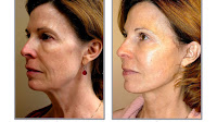 Rhytidectomy - Mini Lift Face