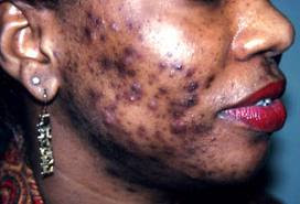 Get Reduce The Appearance Of Dark Spots, Acne Scars and Sun Damaged
