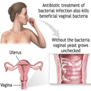 Yeast Infections In Women