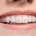 Niềng răng hô nhẹ có hiệu quả không?