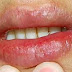 Labios agrietados - Causas, síntomas y tratamiento