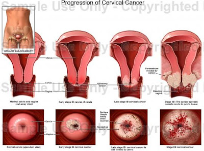 cara mencegah kanker serviks