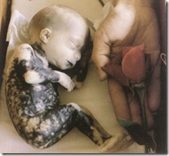 Abortion