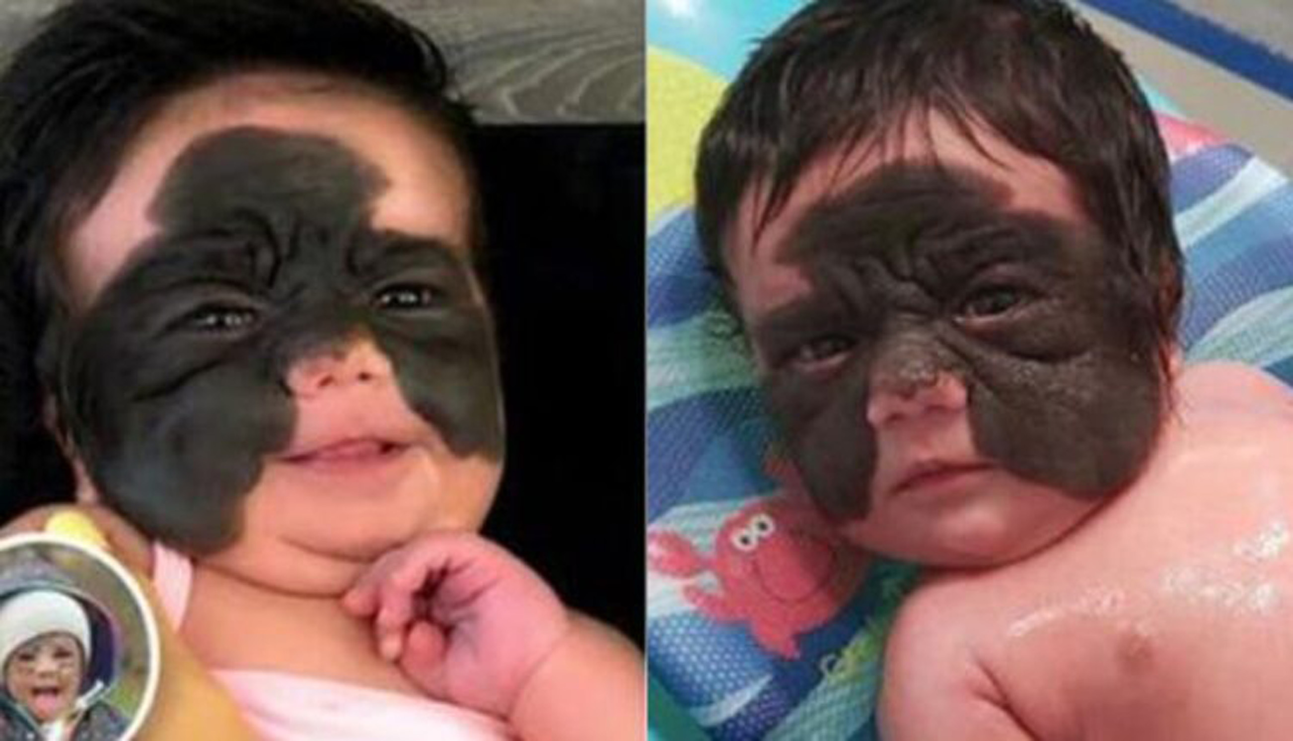 2-Year-Old Girl Finally Has ‘Batman’ Birthmark Removed After Pioneering Surgery