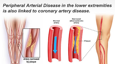 Peripheral Vascular Disease Pictures