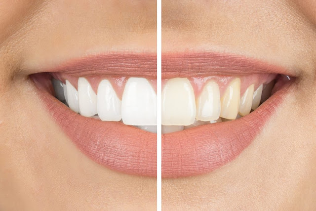 How Zoom Teeth Whitening Works zoom whitening before and after