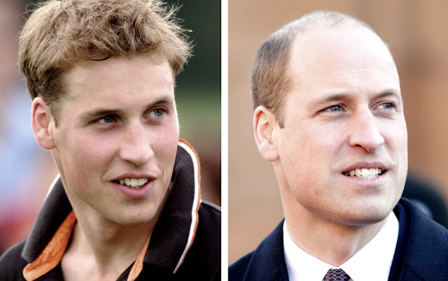 Prince William hair loss