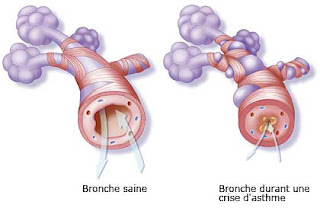 la muqueuse qui recouvre l'intérieur des bronches gonfle