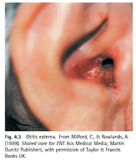 Otitis Externa