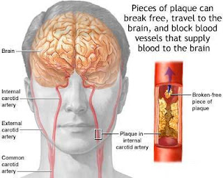 Stress Stroke Symptoms