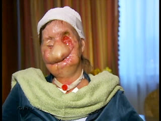 Face Transplants of Charla Nash Before