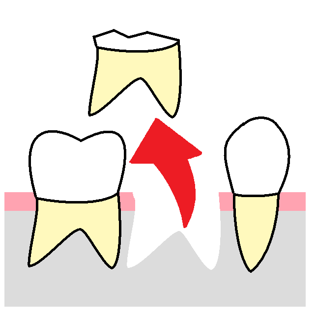 歯医者 歯科医院の無料素材 イラスト 写真 配布物 ブログ 抜歯してからインプラントまでの流れのイラスト