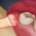 Răng khôn mọc lệch gây đau phải làm sao?