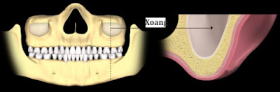 Nâng xoang hàm trong cấy ghép răng implant