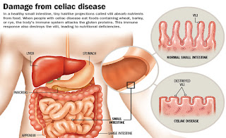 Healing intestinal tract in celiac disease