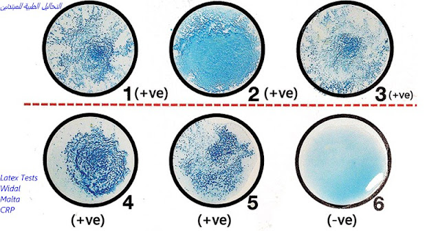 Widal - Malta - CRP .