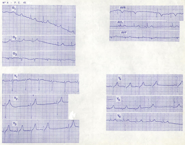 bài tập ecg