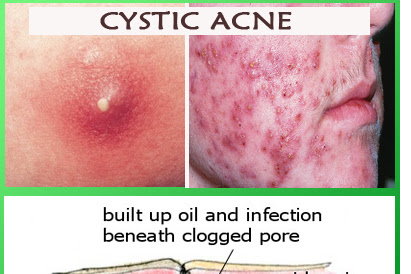 Cystic Acne 