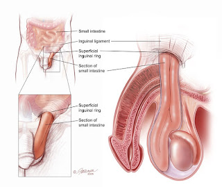 hernia