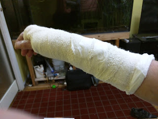 Broken right wrist